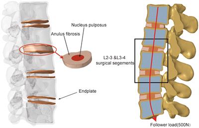 Biomechanical study of two-level oblique lumbar interbody fusion with different types of lateral instrumentation: a finite element analysis